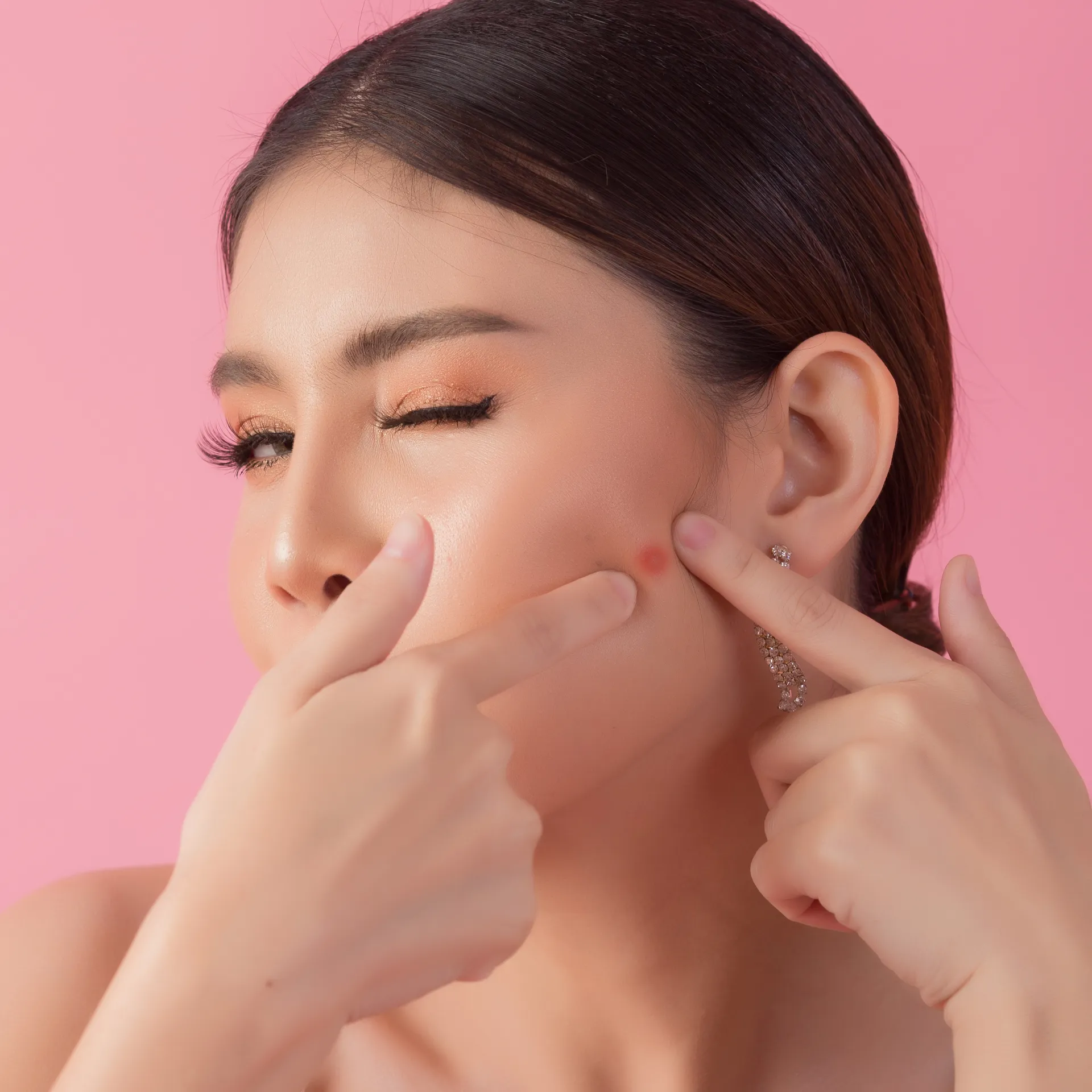 How to Pop a Pimple (If You Must)