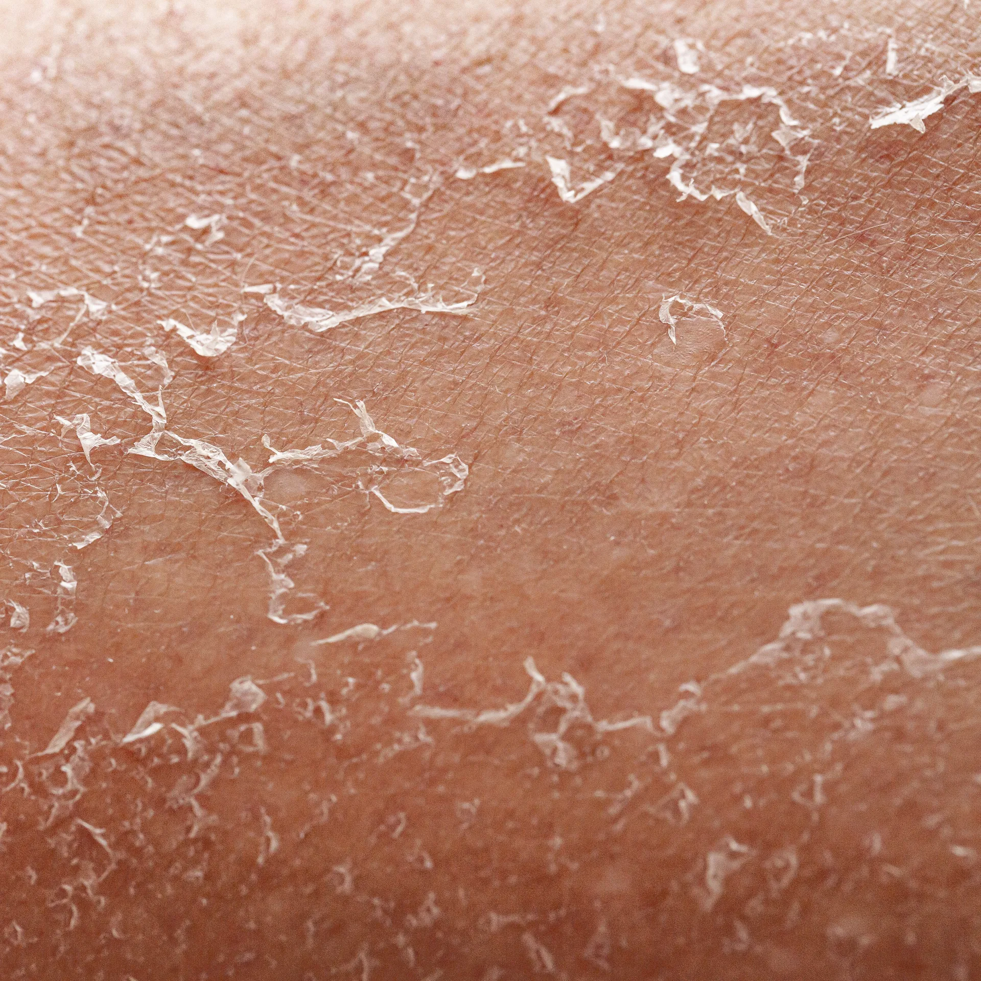 Is Your Skin Dry or Dehydrated?